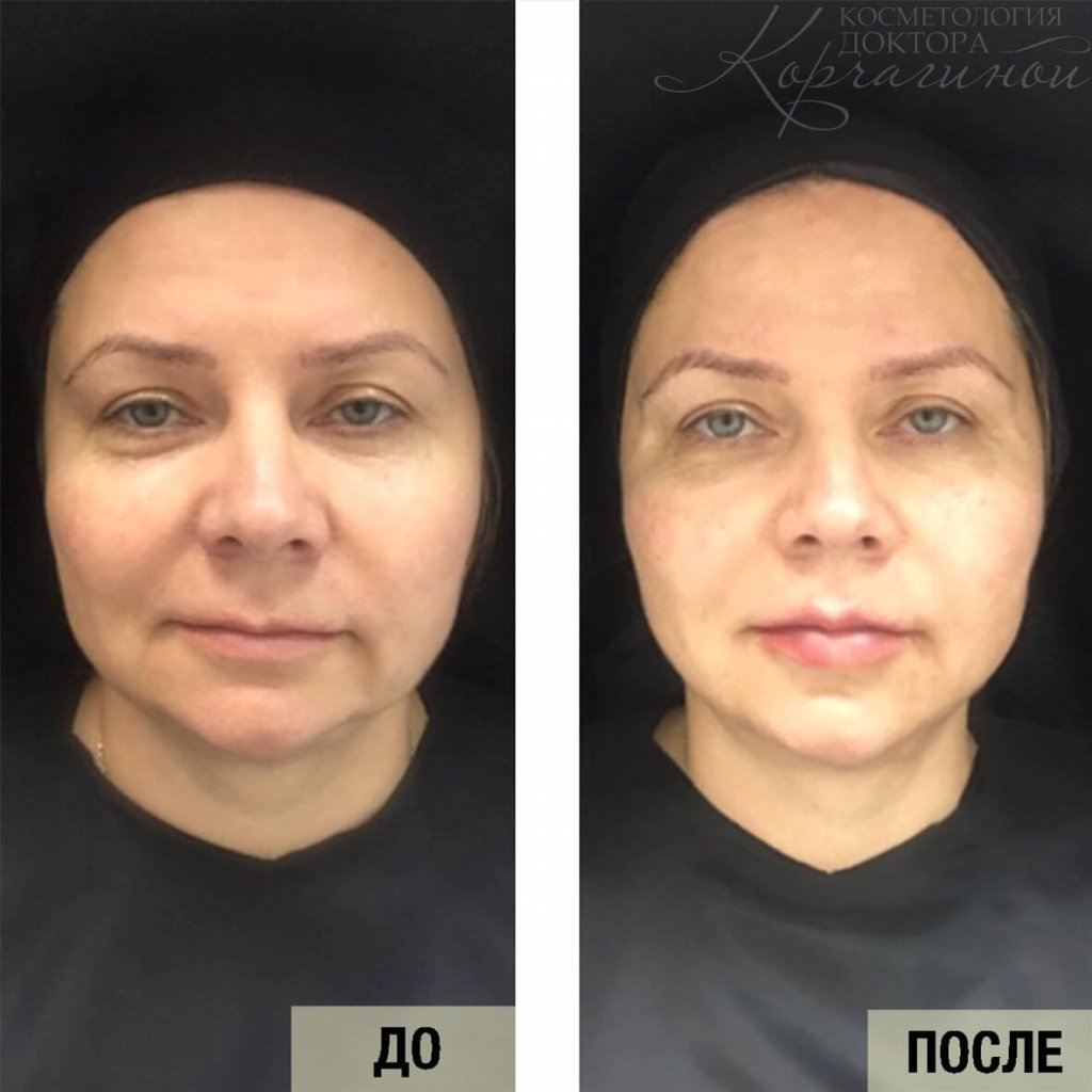Скулы косметология до и после