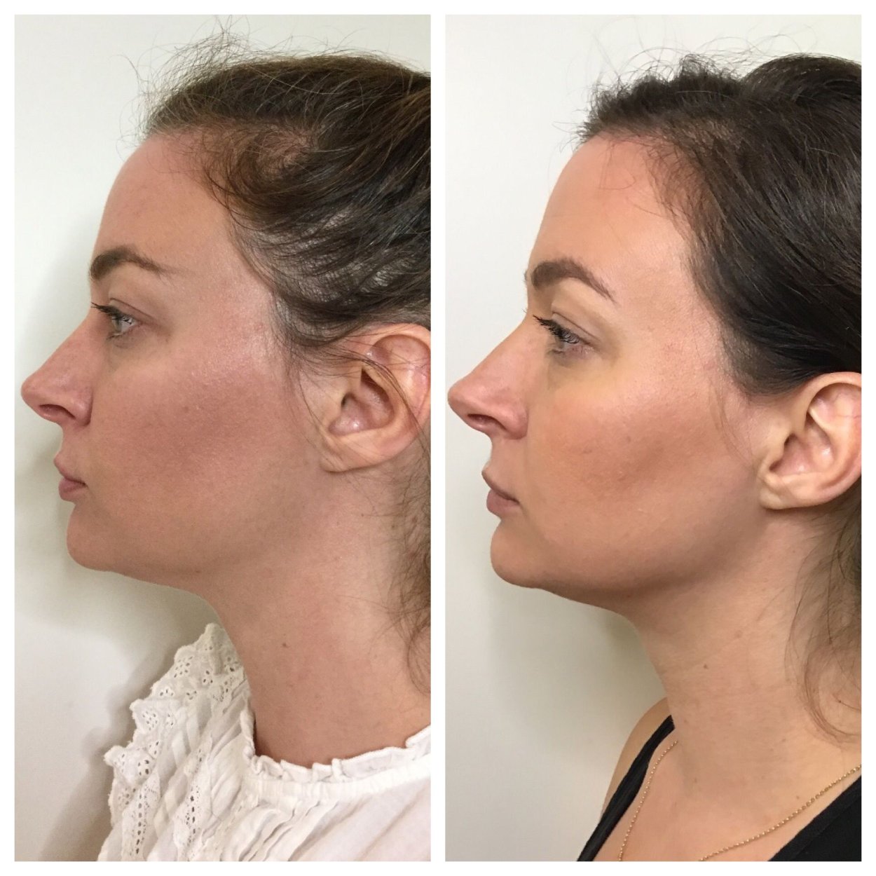 Jawline Contour
