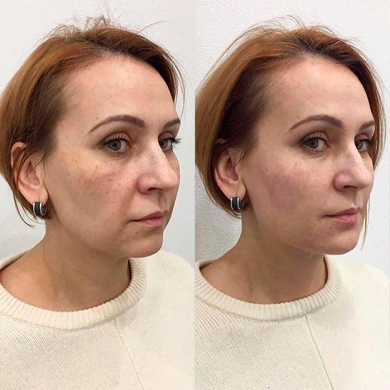 Контурная пластика скул