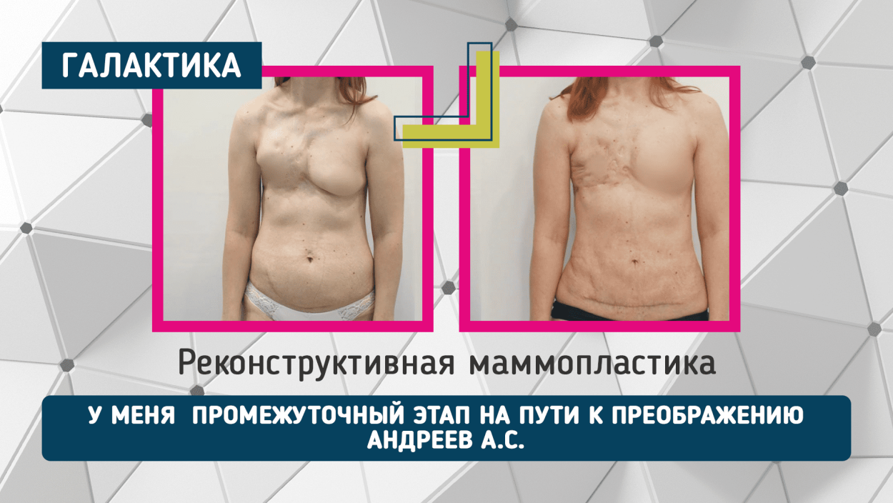 Реконструкция молочных желез после мастэктомии