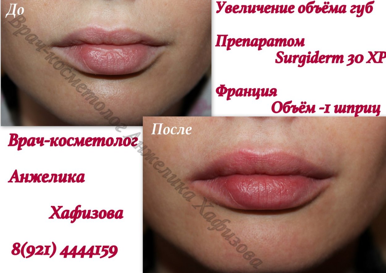 Увеличение губ в Михайловске