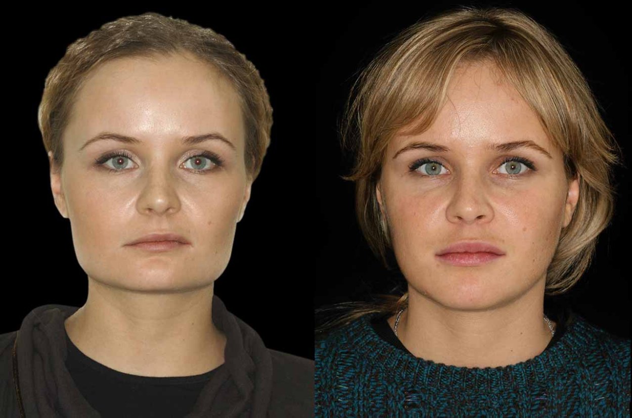Асимметрия лица