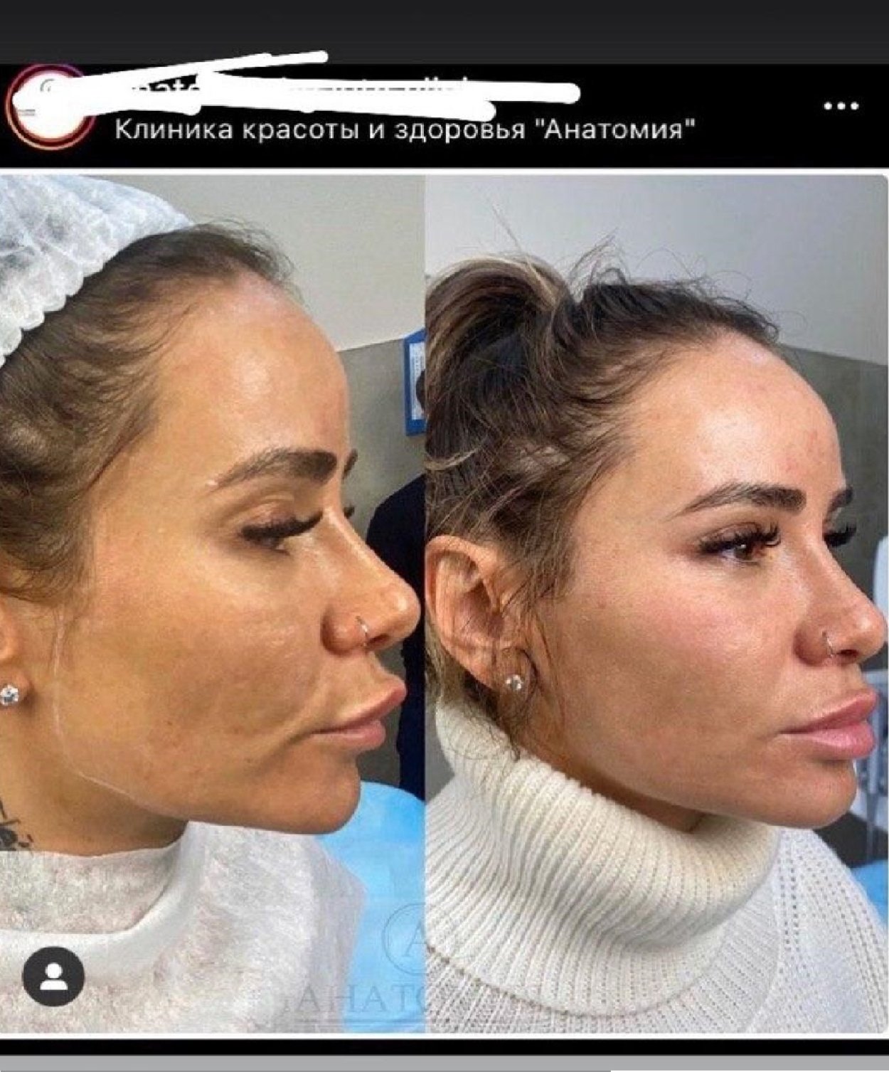 Айза ринопластика
