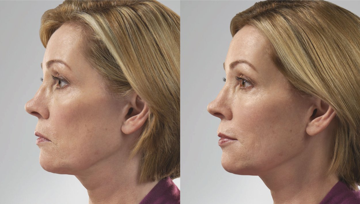 Juvederm Voluma скулы