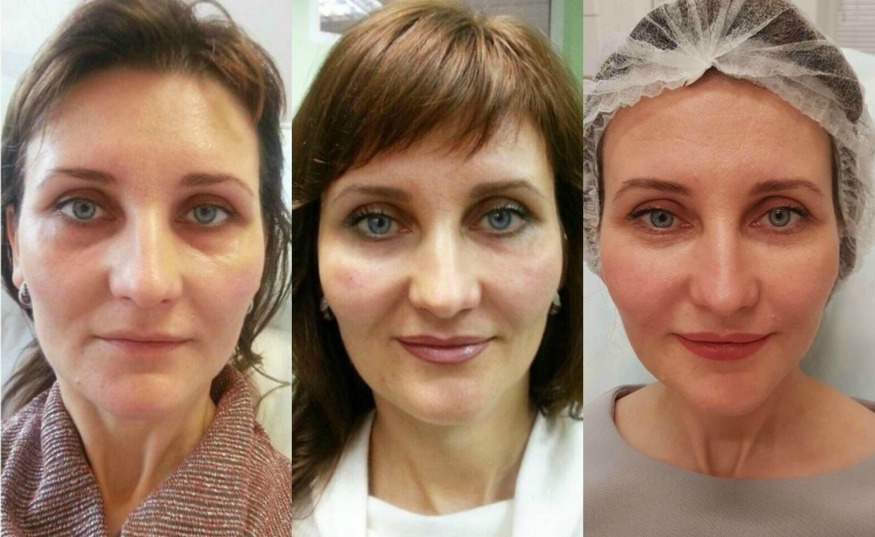 Контурная пластика лица