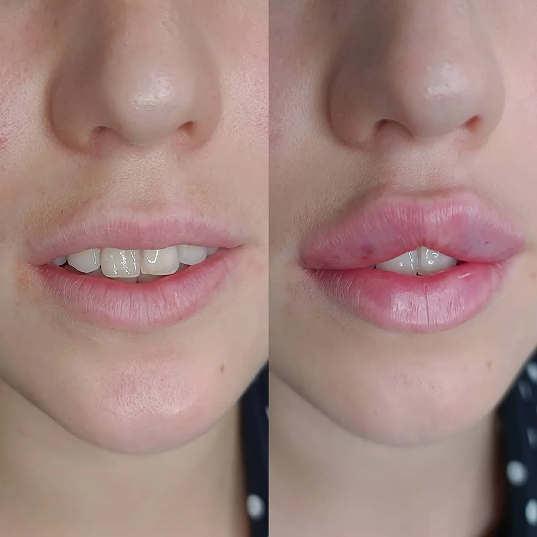 Губы бантиком до и после. Форма губ бантиком. Плоские увеличенные губы. Техника увеличения губ бантиком.
