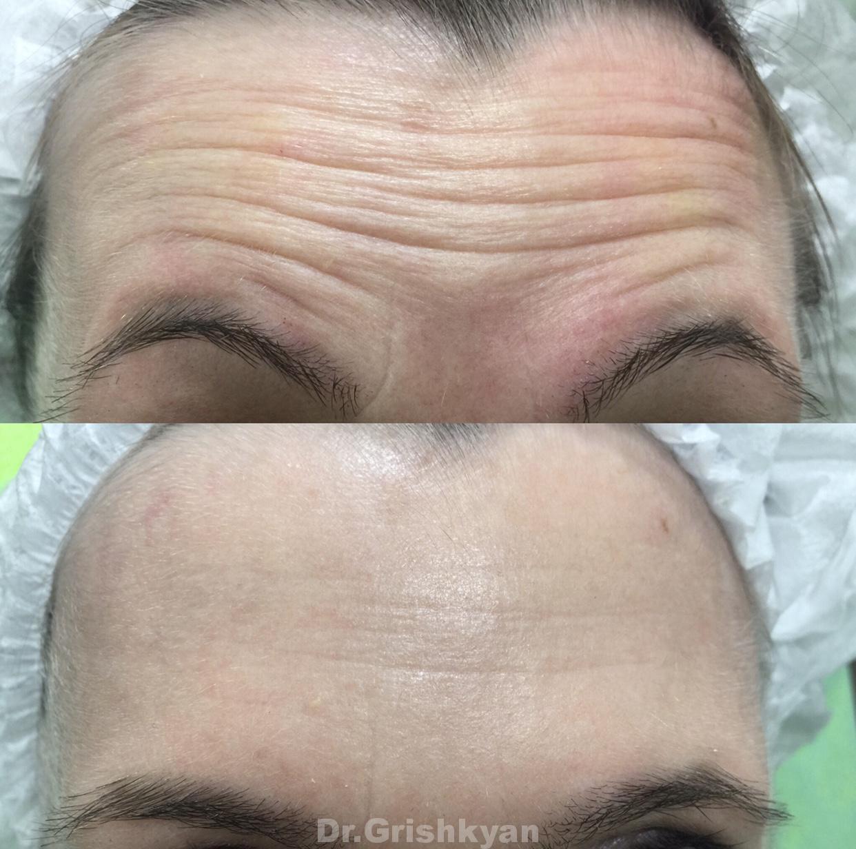 Эффект ботокса