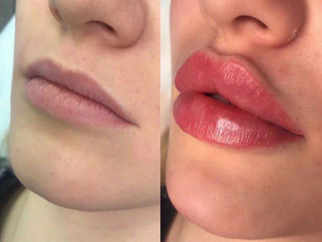 Губы накаченные гиалуроновой кислотой 1 мл