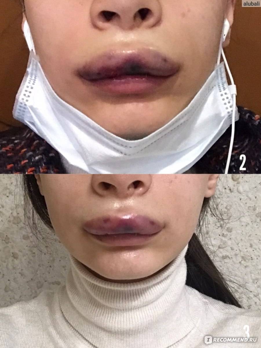 Гиалуроновая кислота в губы