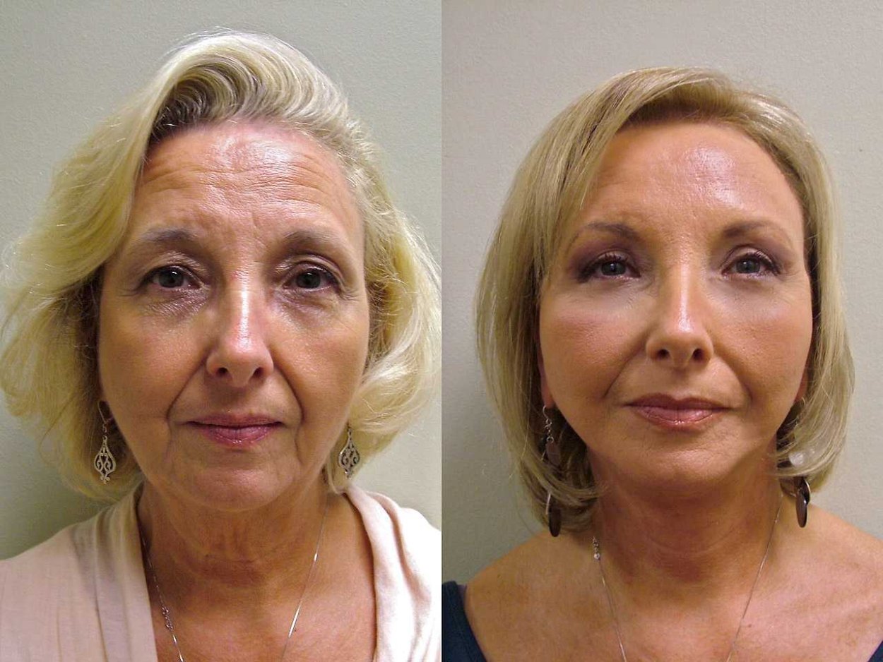 Sculptra полимолочная кислота
