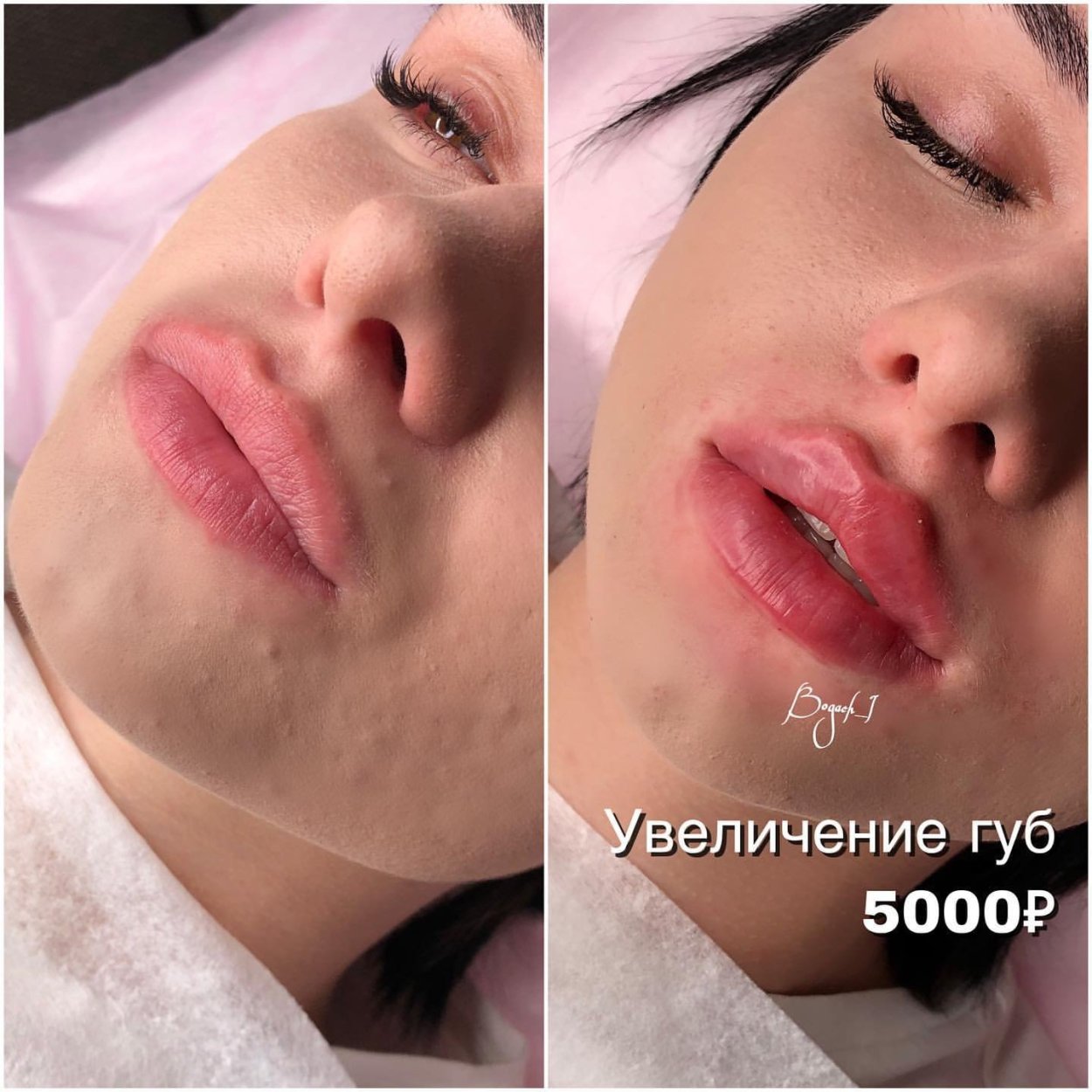 Формы губ для увеличения гиалуроновой кислотой