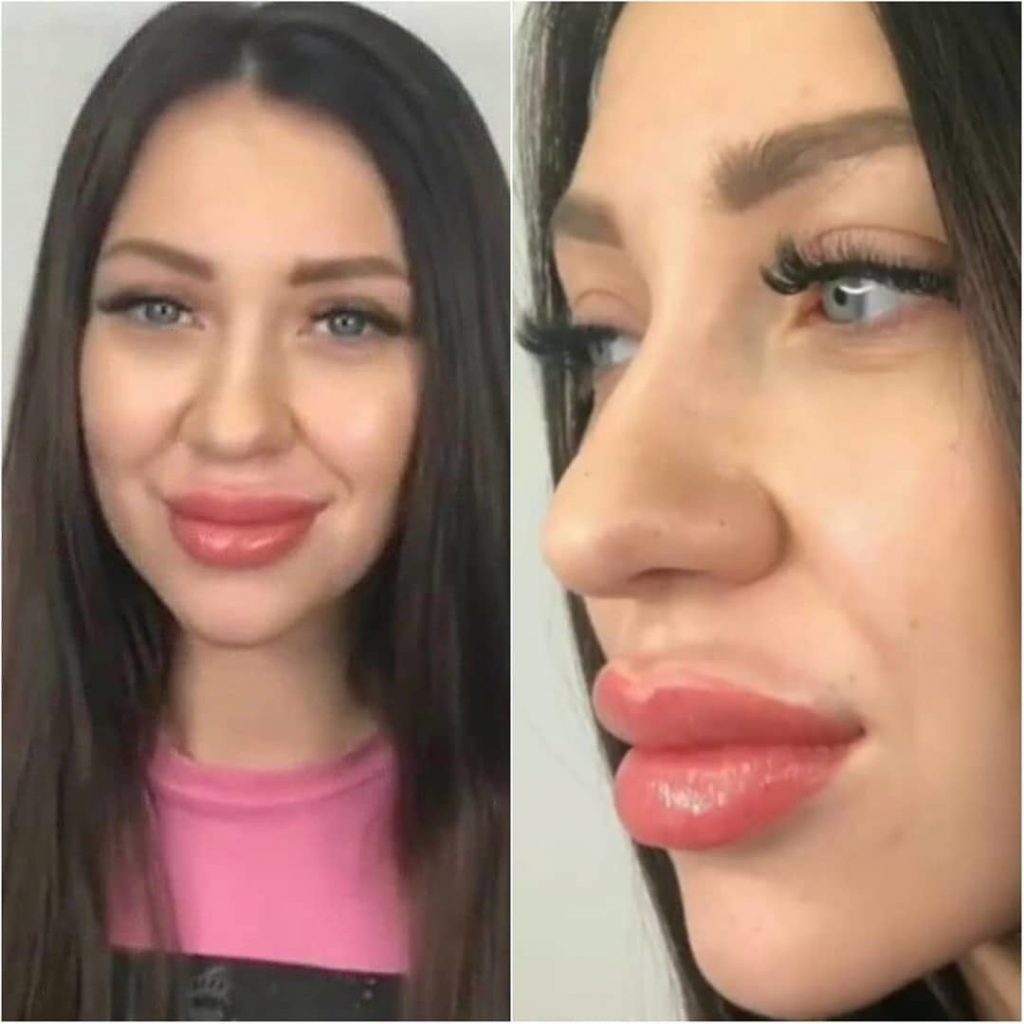 Увеличенные губы красивые