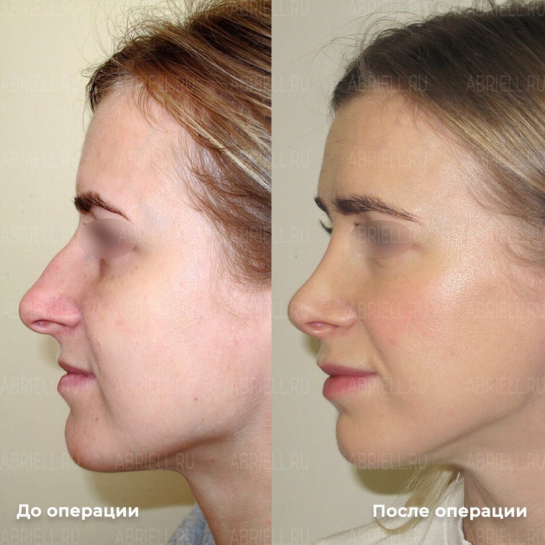 Хрящик выпирает на кончике носа