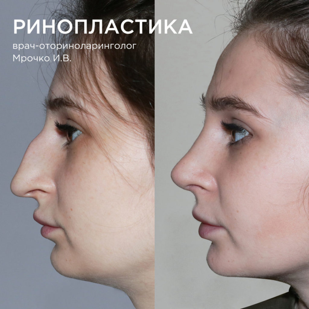 Ринопластика курносого носа до и после