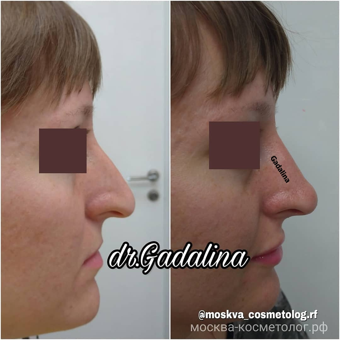 Нос без горбинки