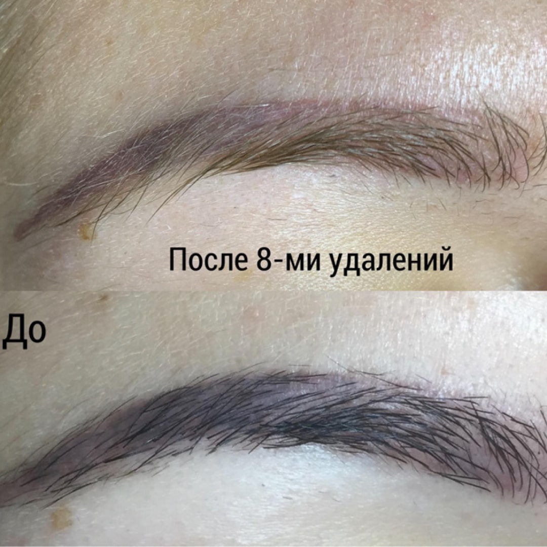 Татуаж бровей после ремувера