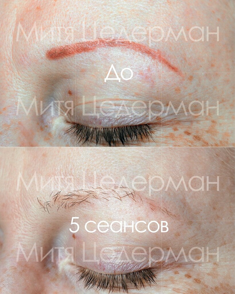 Лазерное удаление перманентного макияжа бровей