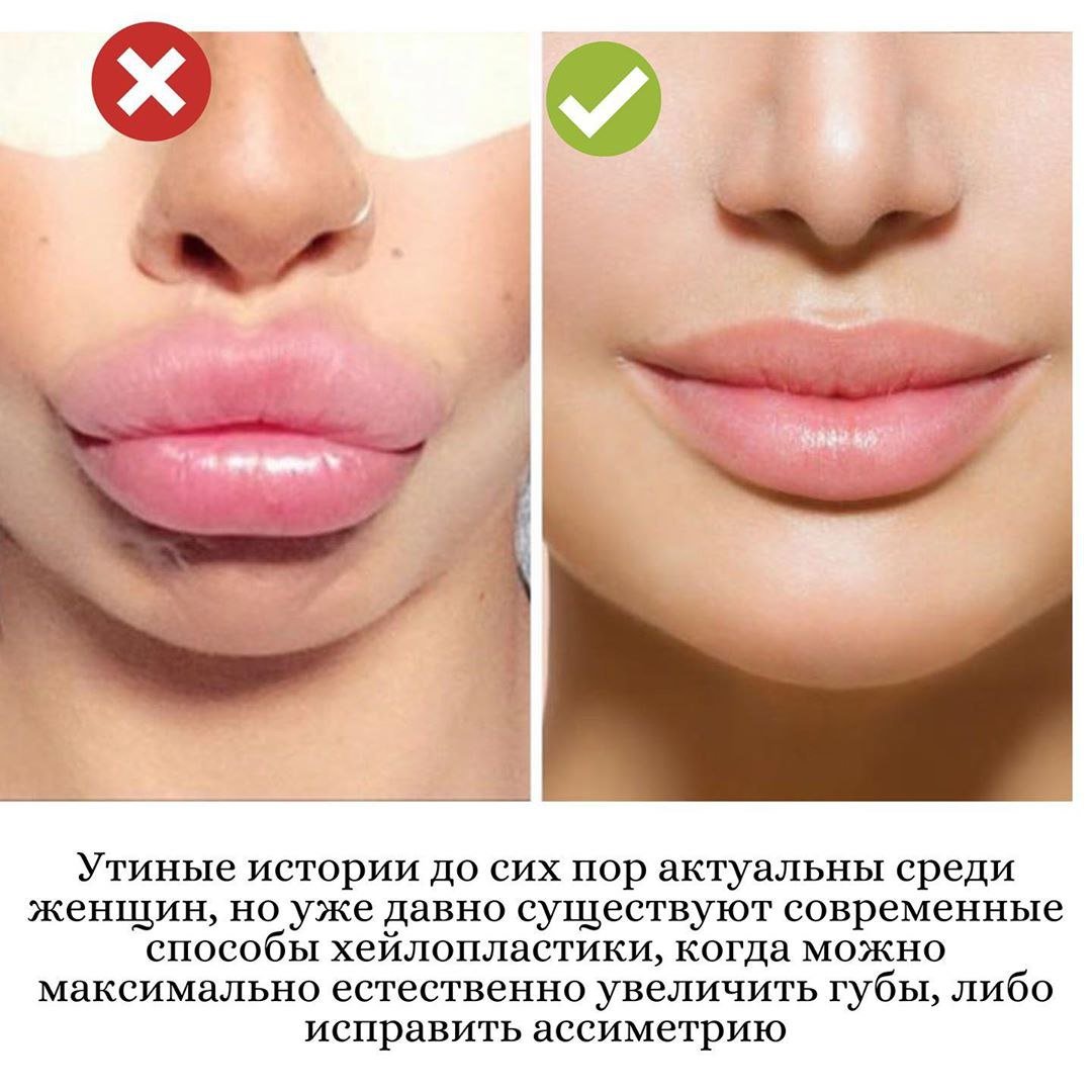Натуральная форма губ