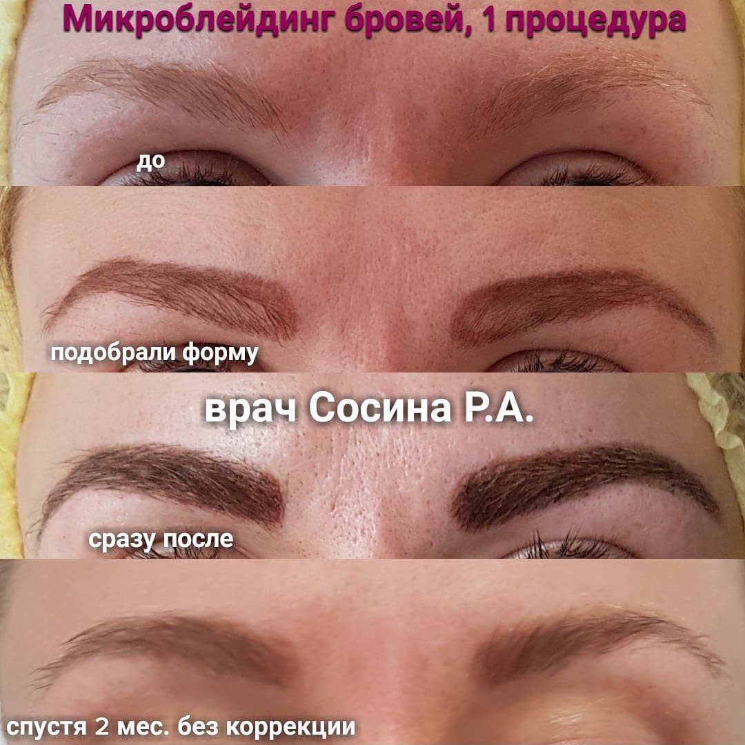 Микроблейдинг через год