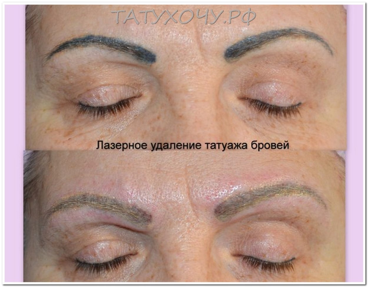 Удаление перманентного макияжа бровей лазером