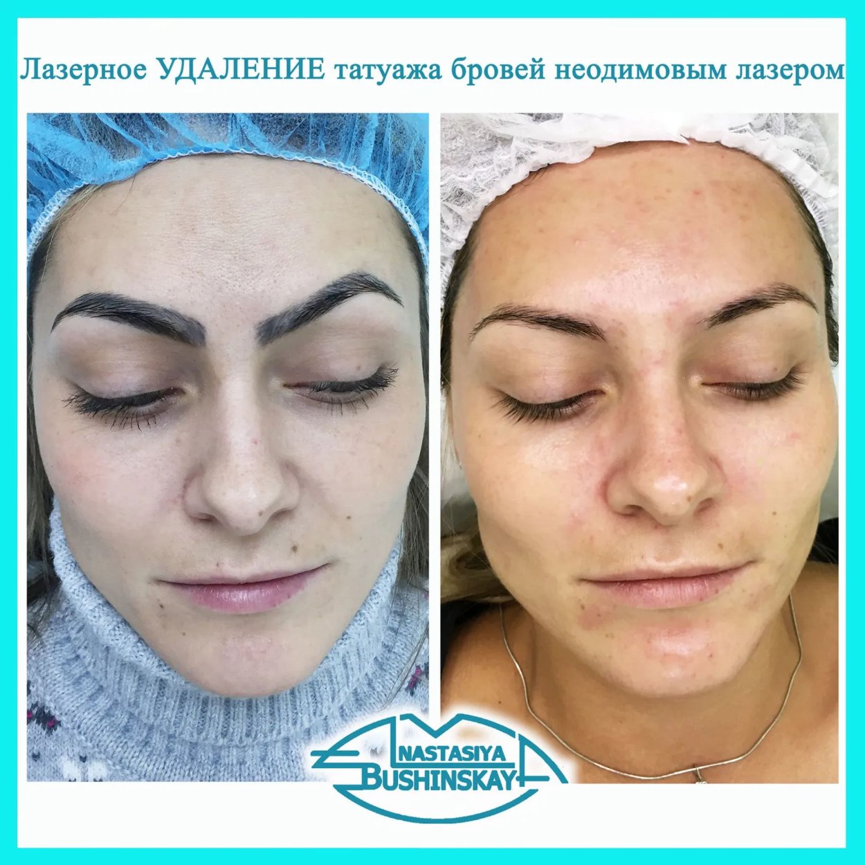 Татуаж бровей лазером