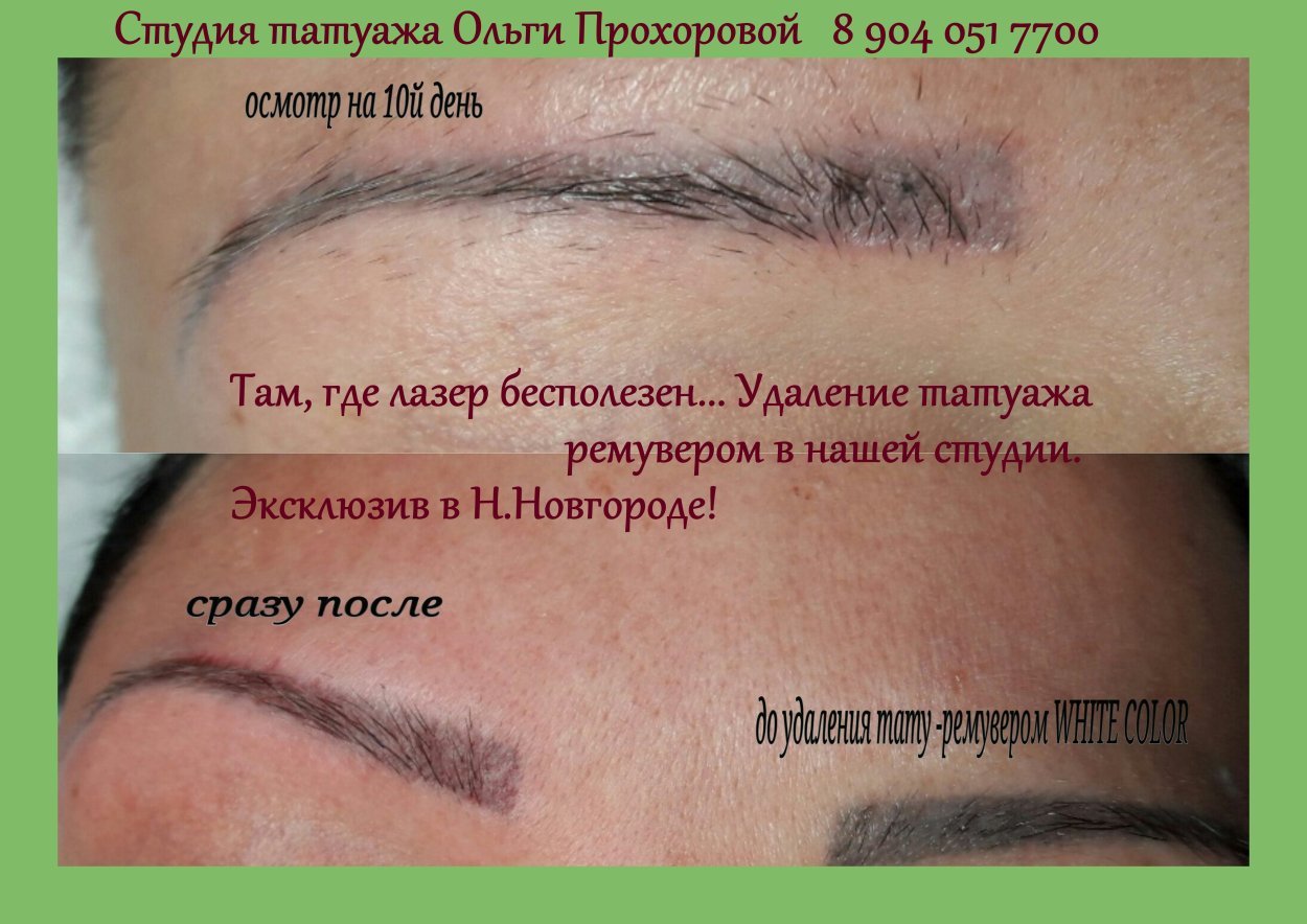 Лазерное удаление перманентного макияжа бровей