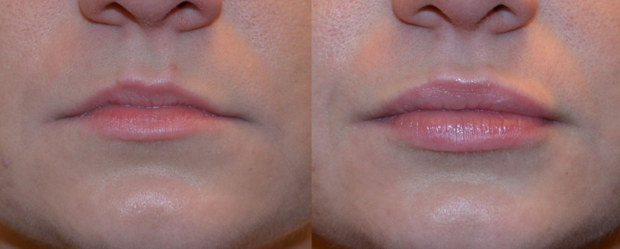Увеличенные губы до и после