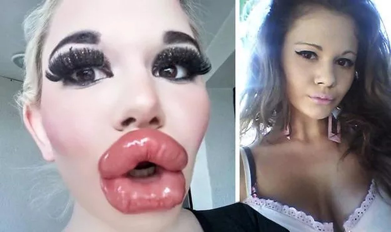 Самые большие накаченные губы в мире