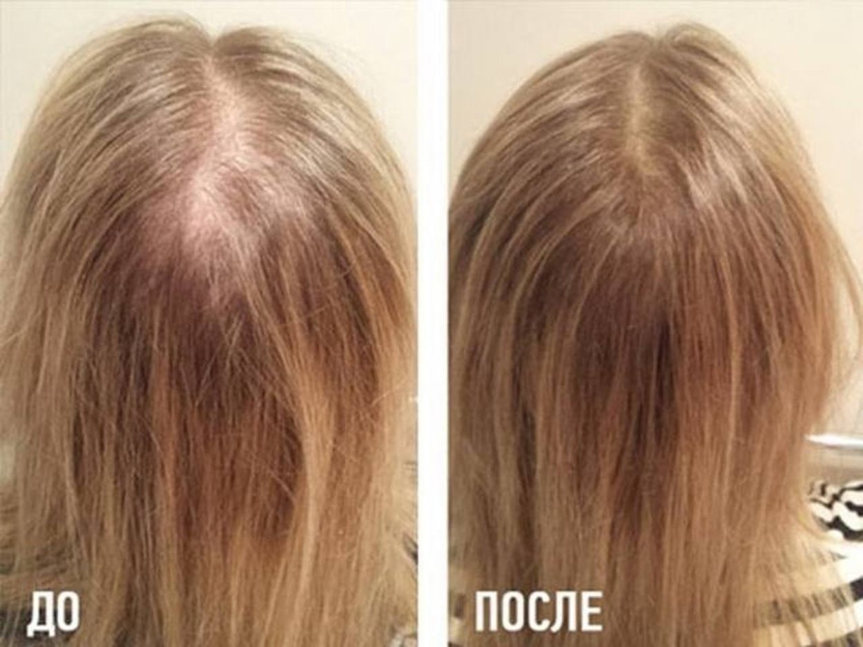 Мезо волос до и после
